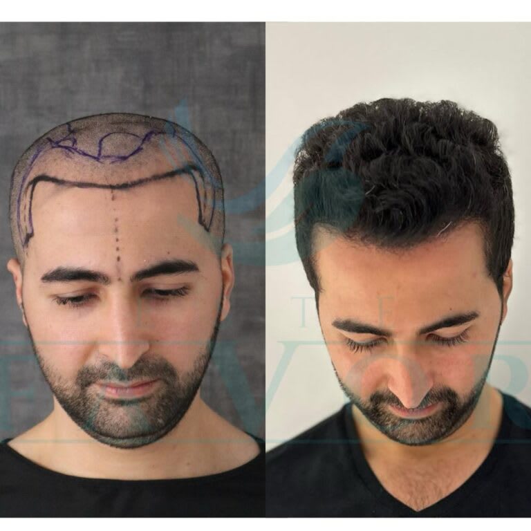 Este Favor | Hair Transplant Turkey | Greffe de cheveux en Turquie | Trasplante Capilar Turquia | interior