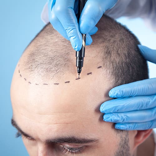 Hair Transplant - Holiday Estetic - Best Hair Transplantation İstanbul gallery image 4
