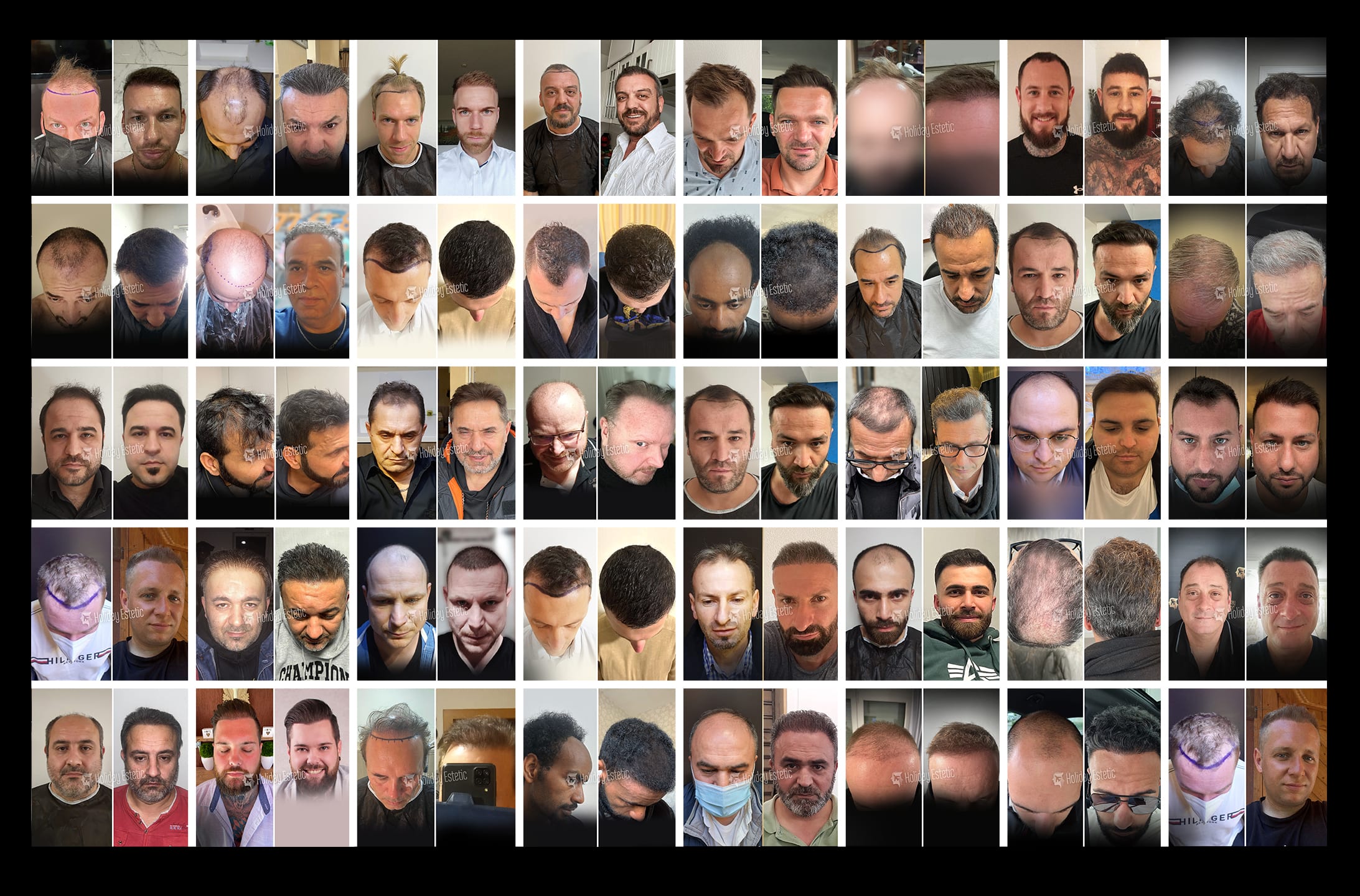 Hair Transplant - Holiday Estetic - Best Hair Transplantation İstanbul gallery image 5