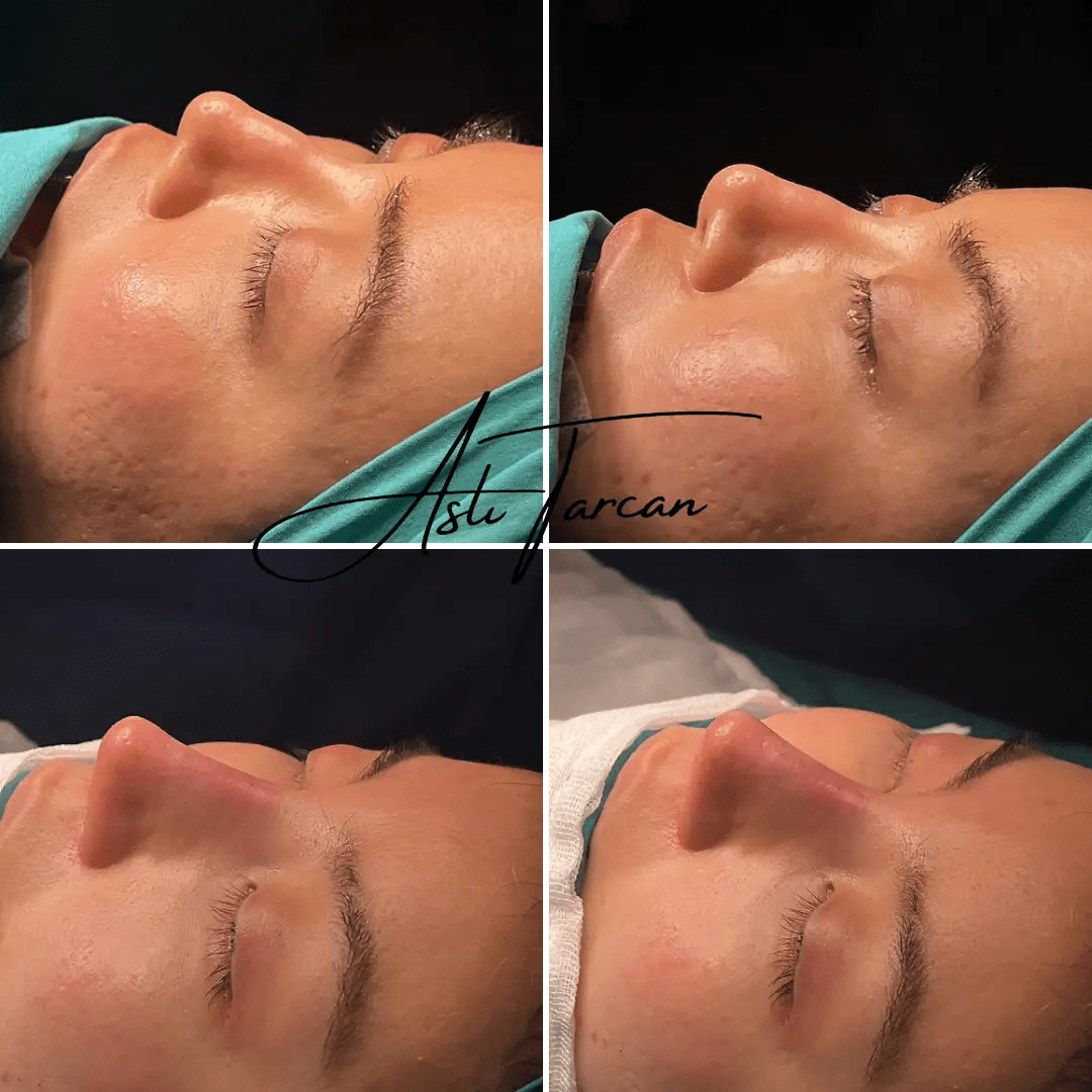 Ethnic Rhinoplasty interior