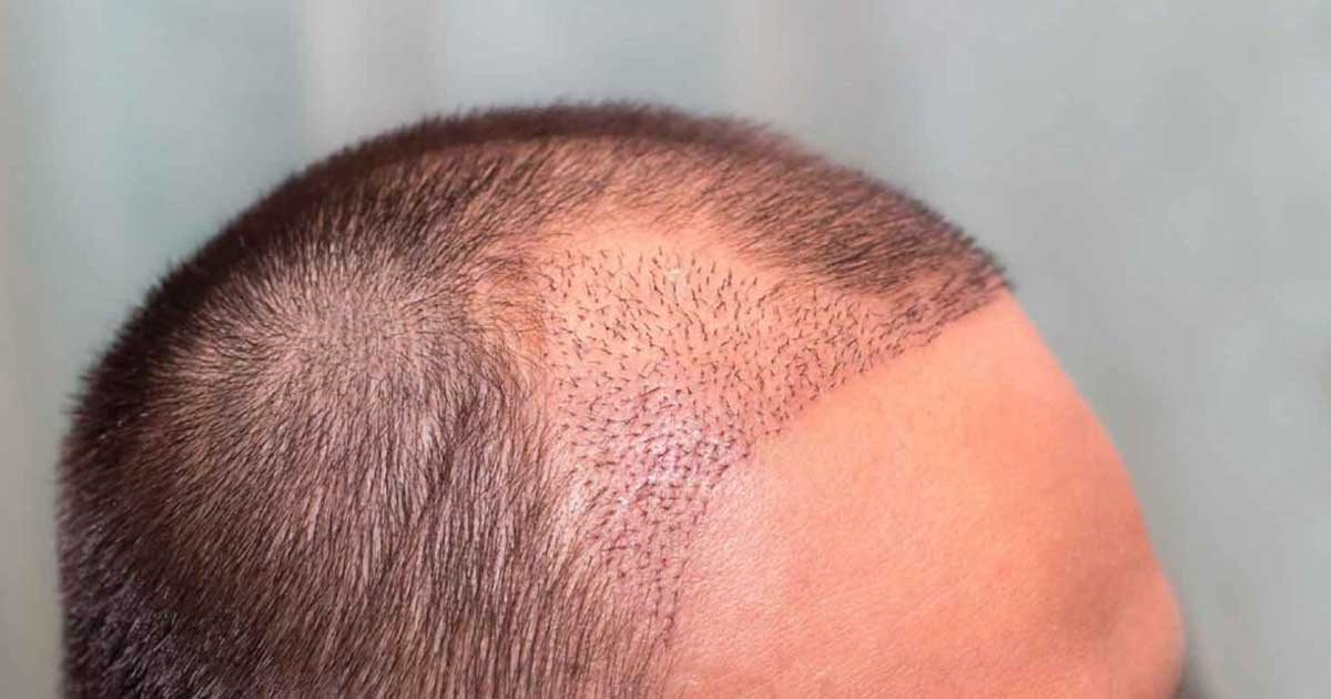 Antalya Hair Transplant Clinic OTEK | OTEK Hair Clinic interior