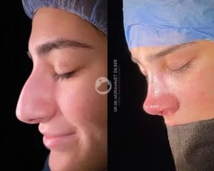 Assoc. Prof. Dr. Muhammet Dilber - Rhinoplasty Turkey | Revision Rhinoplasty Turkey gallery image 1