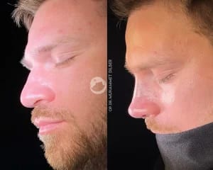 Assoc. Prof. Dr. Muhammet Dilber - Rhinoplasty Turkey | Revision Rhinoplasty Turkey gallery image 2