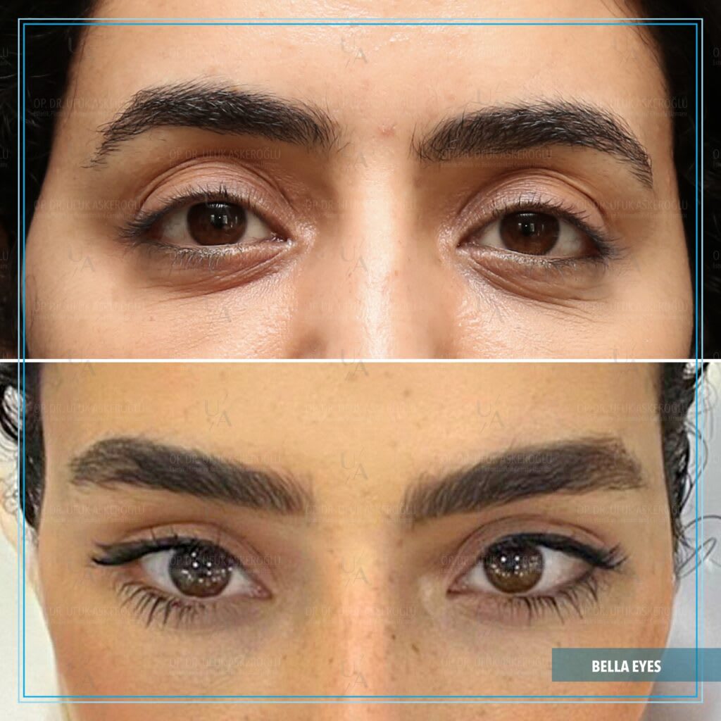 Op. Dr. Ufuk Askeroğlu | Bella Eyes®️ | Trinity Lift®️ | Hollywood Yanağı®️| Face Lift | Rhinoplasty | Liposuction gallery image 1
