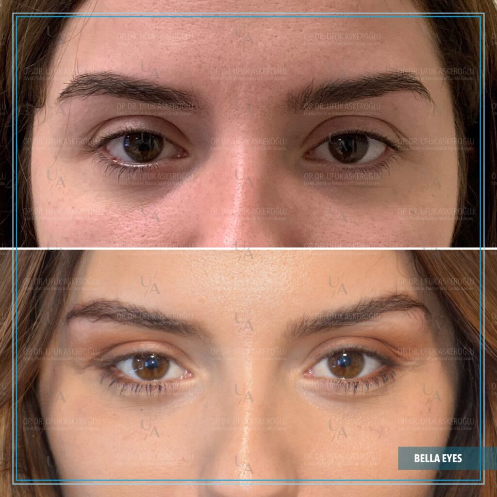 Op. Dr. Ufuk Askeroğlu | Bella Eyes®️ | Trinity Lift®️ | Hollywood Yanağı®️| Face Lift | Rhinoplasty | Liposuction gallery image 2