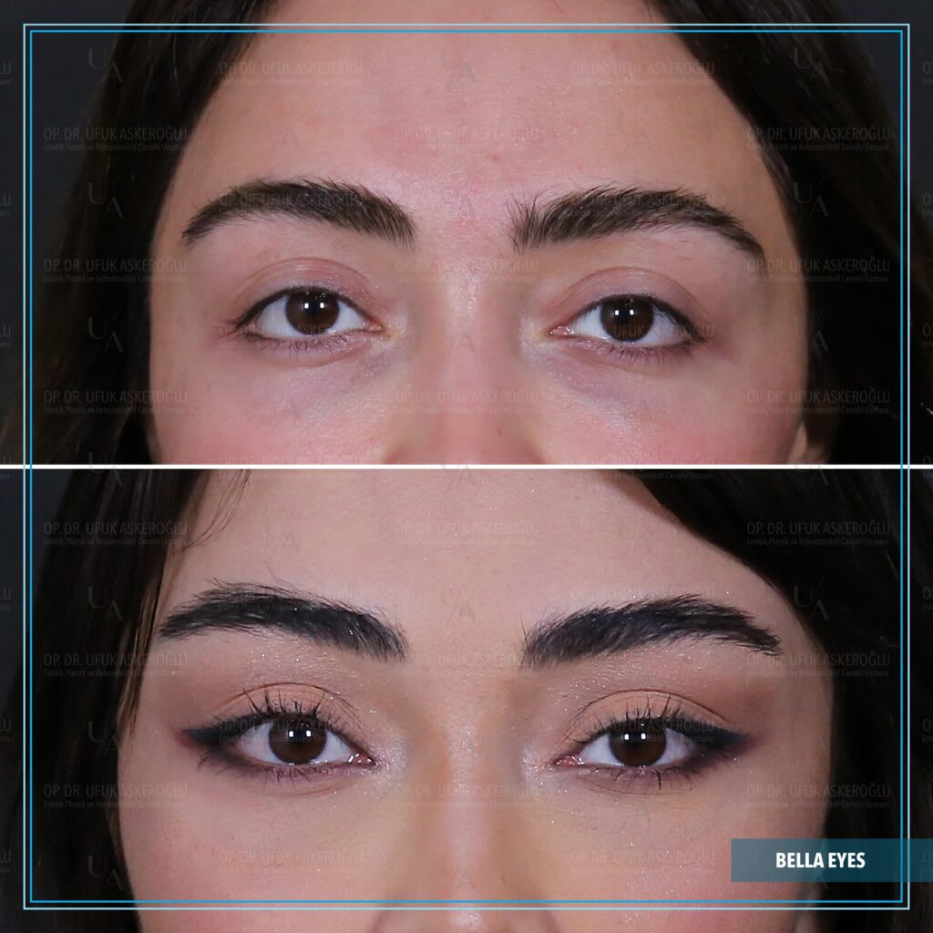 Op. Dr. Ufuk Askeroğlu | Bella Eyes®️ | Trinity Lift®️ | Hollywood Yanağı®️| Face Lift | Rhinoplasty | Liposuction gallery image 3