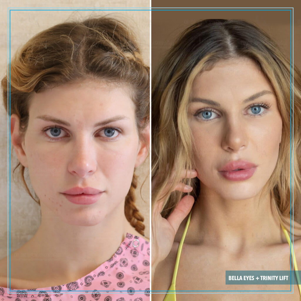 Op. Dr. Ufuk Askeroğlu | Bella Eyes®️ | Trinity Lift®️ | Hollywood Yanağı®️| Face Lift | Rhinoplasty | Liposuction gallery image 5