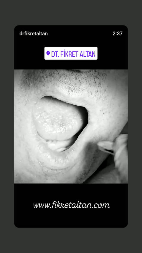 ALTAN KLİNİK | DİŞ HEKİMİ FİKRET ALTAN | İmplant, Zirkonyum, Gülüş Tasarımı, Diş Beyazlatma, Estetik Diş | Maslak İSTANBUL gallery image 2
