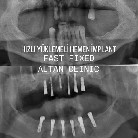 ALTAN KLİNİK | DİŞ HEKİMİ FİKRET ALTAN | İmplant, Zirkonyum, Gülüş Tasarımı, Diş Beyazlatma, Estetik Diş | Maslak İSTANBUL gallery image 3