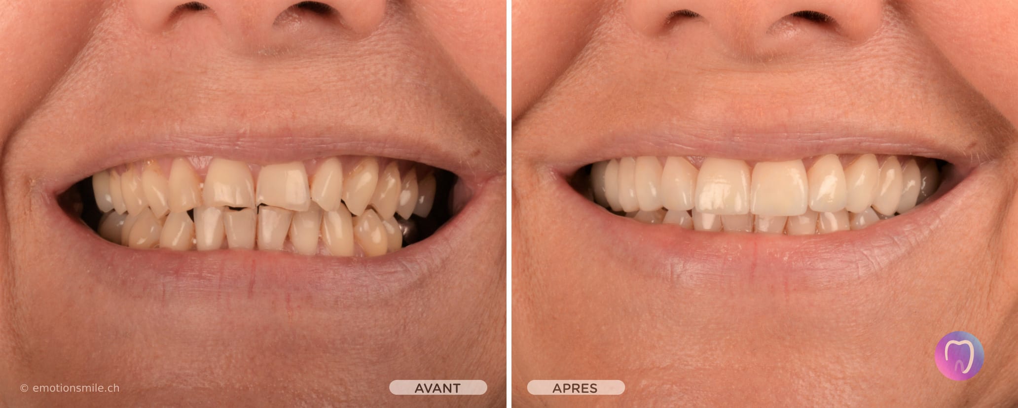 Emotion Smile - Facettes dentaires et blanchiment et alignement des dents à Lausanne. gallery image 1