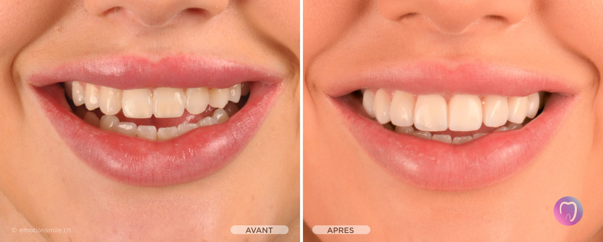 Emotion Smile - Facettes dentaires et blanchiment et alignement des dents à Lausanne. gallery image 2