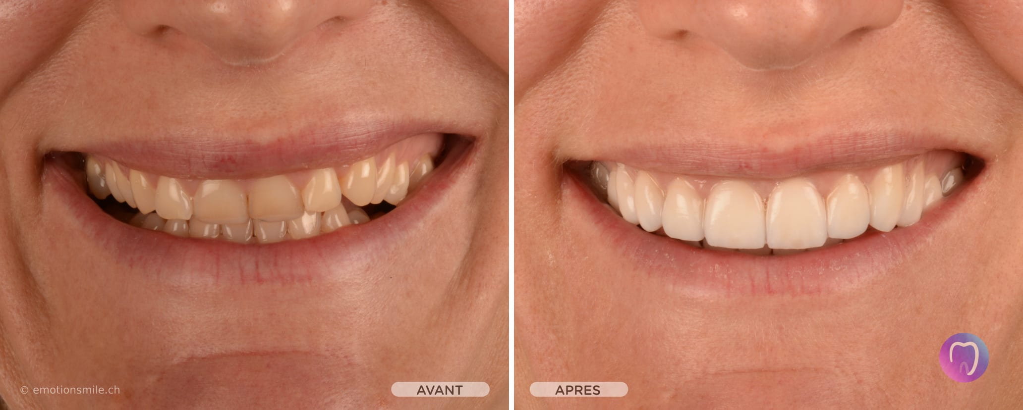 Emotion Smile - Facettes dentaires et blanchiment et alignement des dents à Lausanne. gallery image 3
