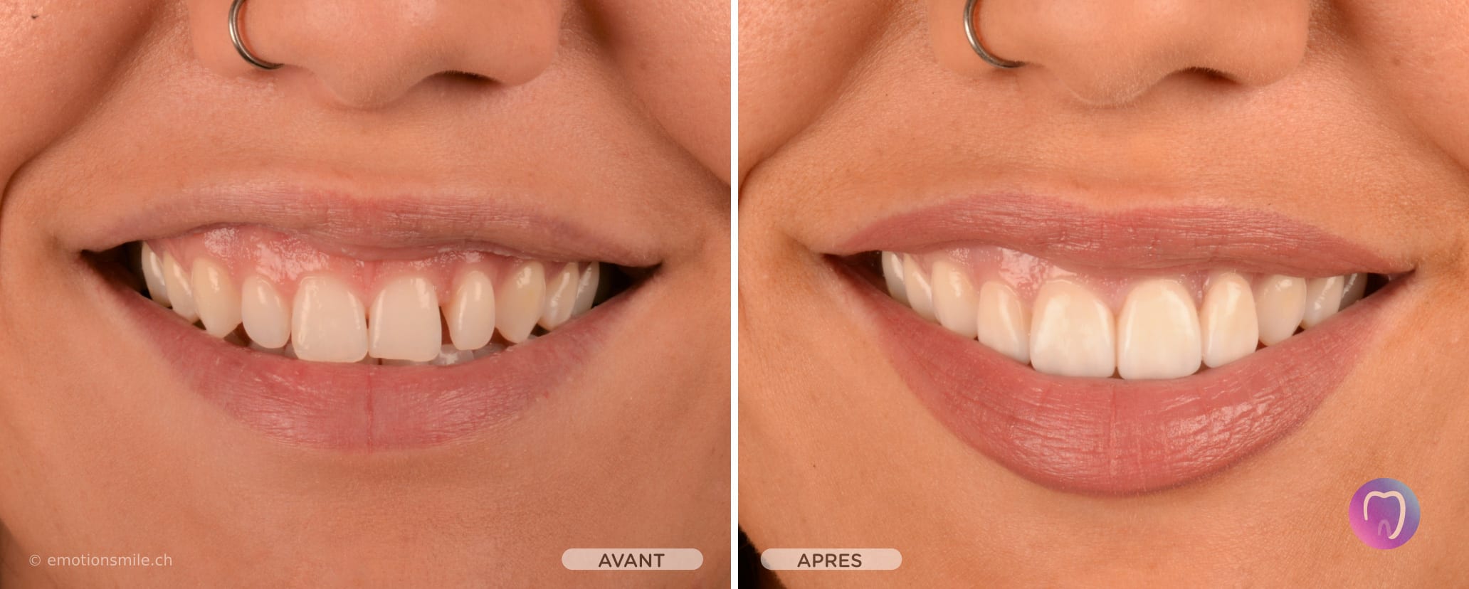 Emotion Smile - Facettes dentaires et blanchiment et alignement des dents à Lausanne. gallery image 4