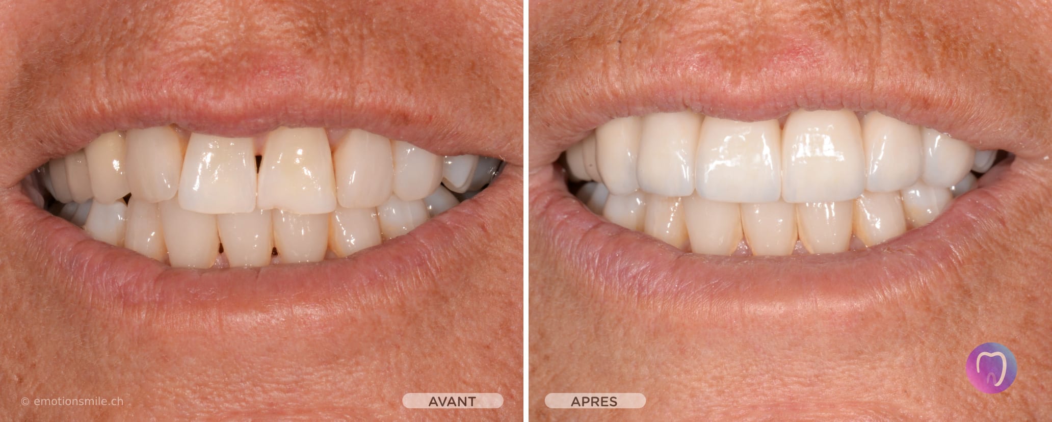 Emotion Smile - Facettes dentaires et blanchiment et alignement des dents à Lausanne. gallery image 5