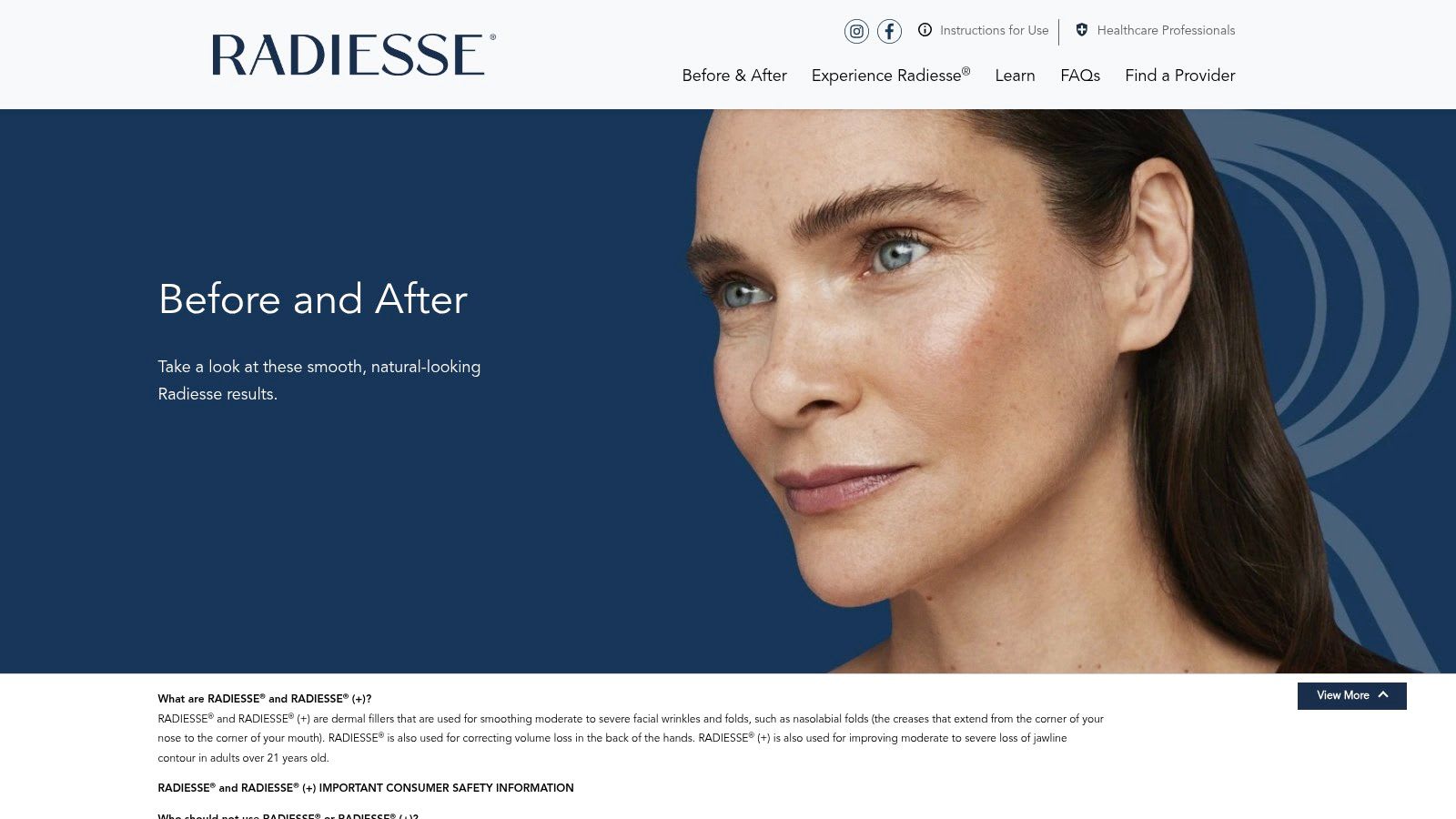 RADIESSE (Merz Aesthetics) official before-and-after gallery