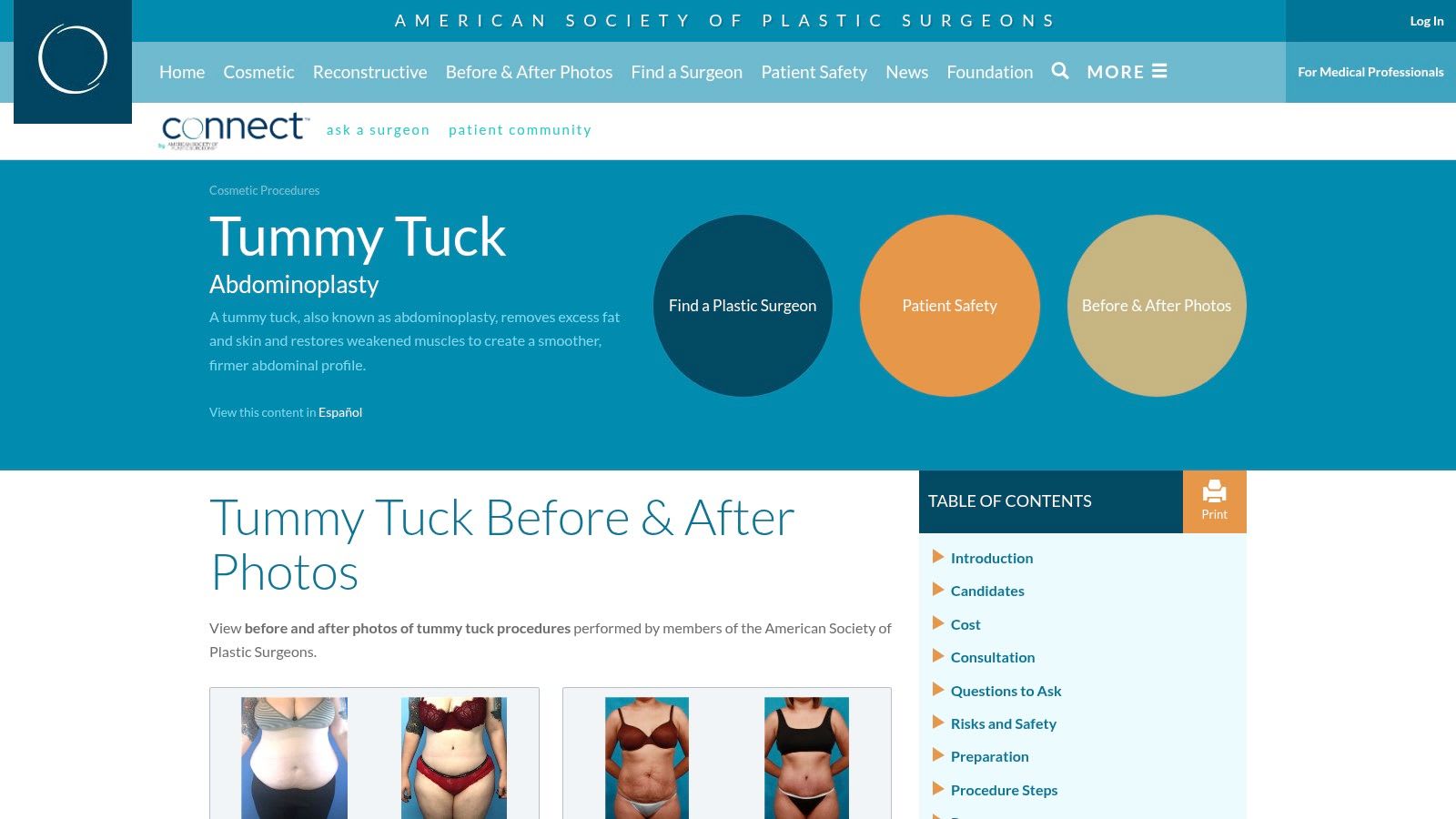 American Society of Plastic Surgeons (ASPS) — Tummy Tuck Photo Library