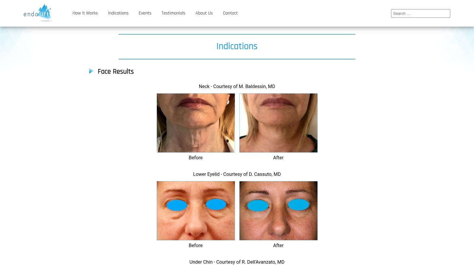 Eufoton USA – Endolift Indikationen (Offizielle Hersteller Galerie)
