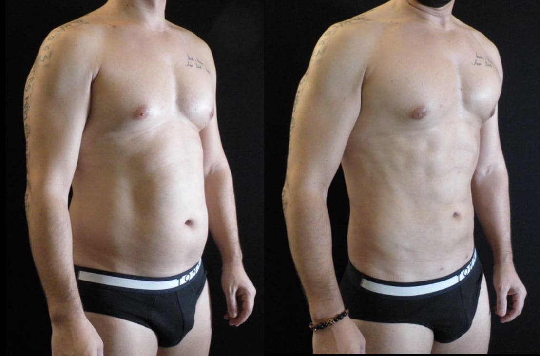 White House Center for Liposuction - Dr Paul v. Waechter-Gniadek, MD gallery image 4