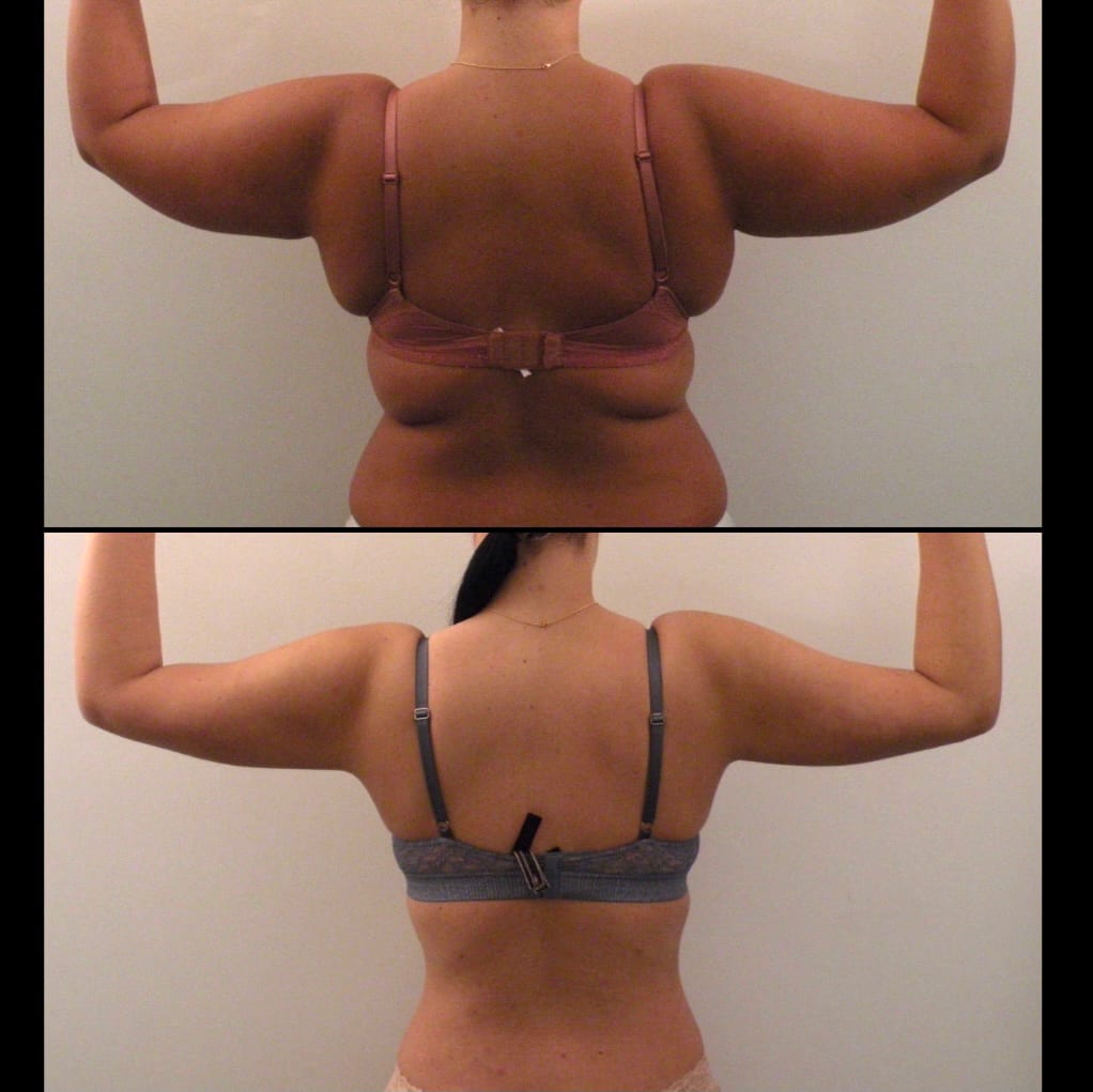 White House Center for Liposuction - Dr Paul v. Waechter-Gniadek, MD gallery image 5