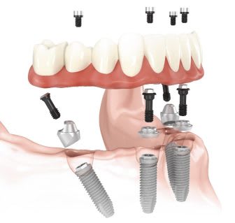 Bodensee Implantatzentrum Dr. Wolfgang Prinz MDSc Zahnarzt/ Implantologie gallery image 7