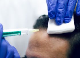 KÖ-HAIR KLINK GmbH Zürich Haartransplantation | Haarpigmentierung Zürich| PRP Behandlung Zürich gallery image 5