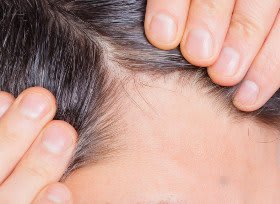 KÖ-HAIR KLINK GmbH Zürich Haartransplantation | Haarpigmentierung Zürich| PRP Behandlung Zürich gallery image 8