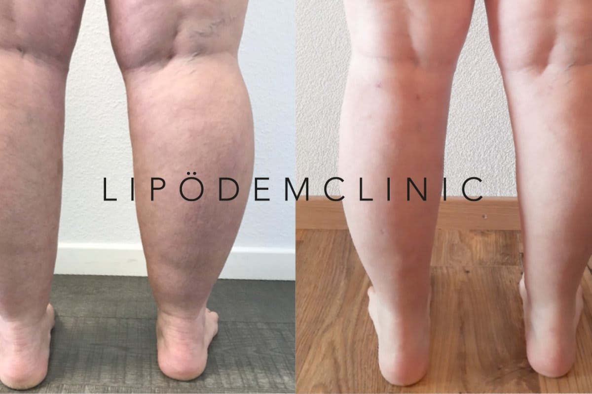 LIPÖDEMCLINIC Zürich gallery image 1