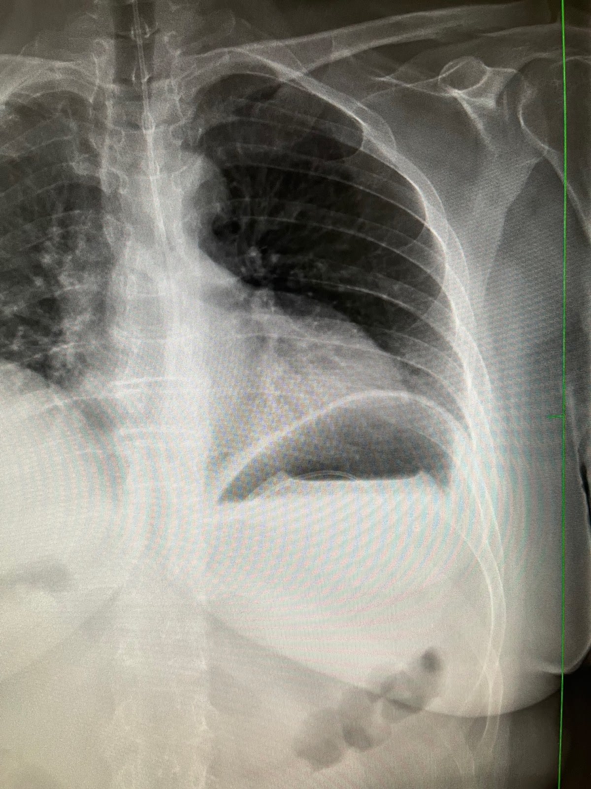 Allurion Balloon Geneva gallery image 1