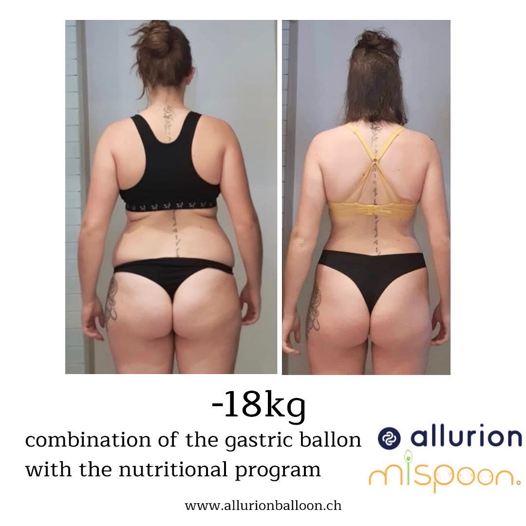 Allurion Balloon Geneva gallery image 2