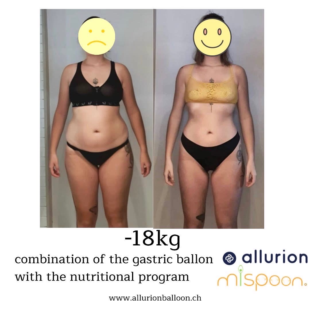 Allurion Balloon Geneva gallery image 3