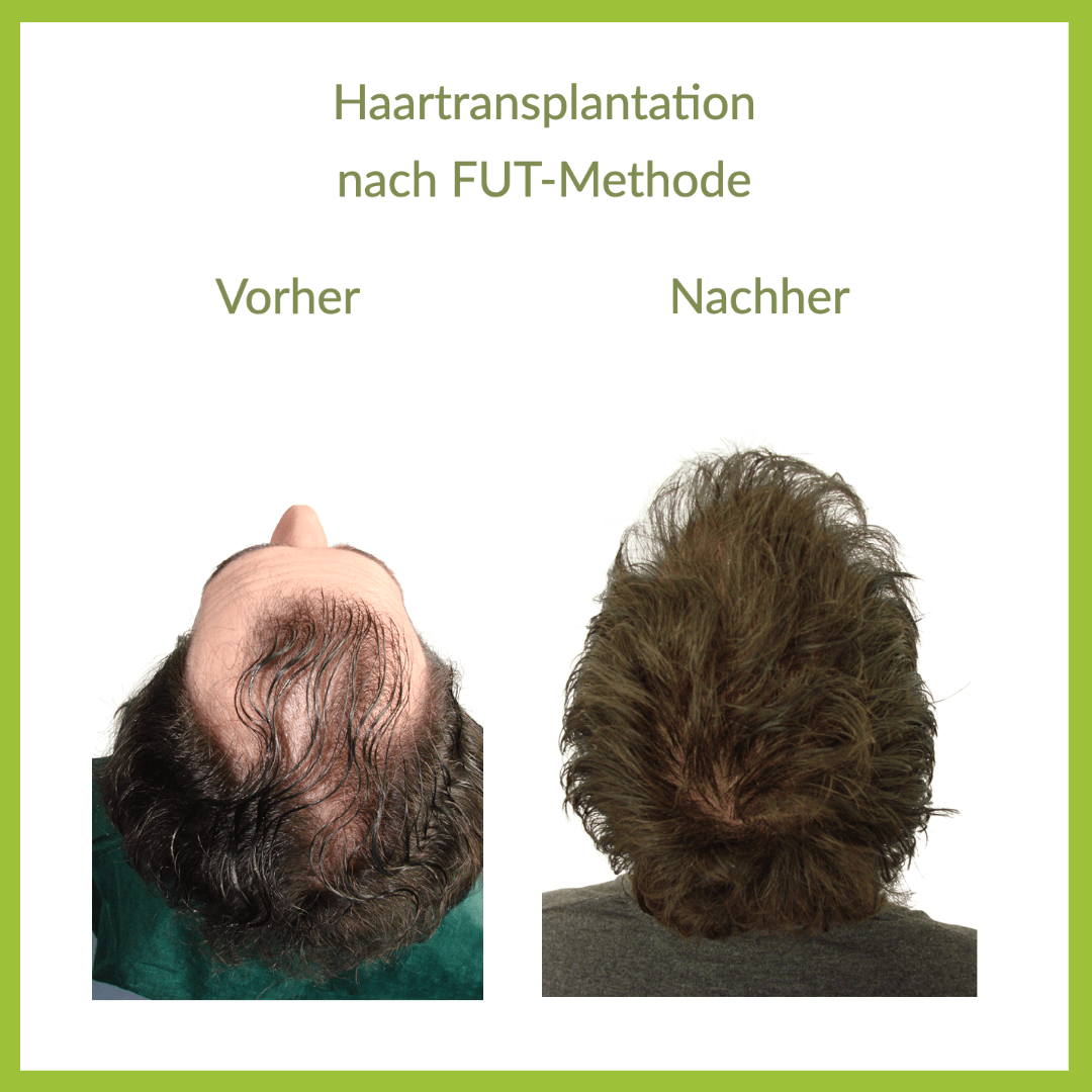 Haartransplantation Bern Heike Maurer gallery image 2
