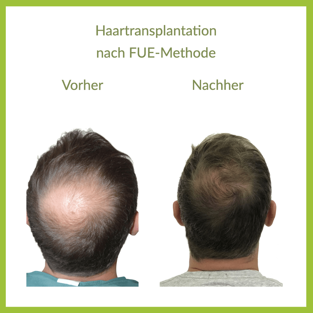 Haartransplantation Bern Heike Maurer gallery image 3