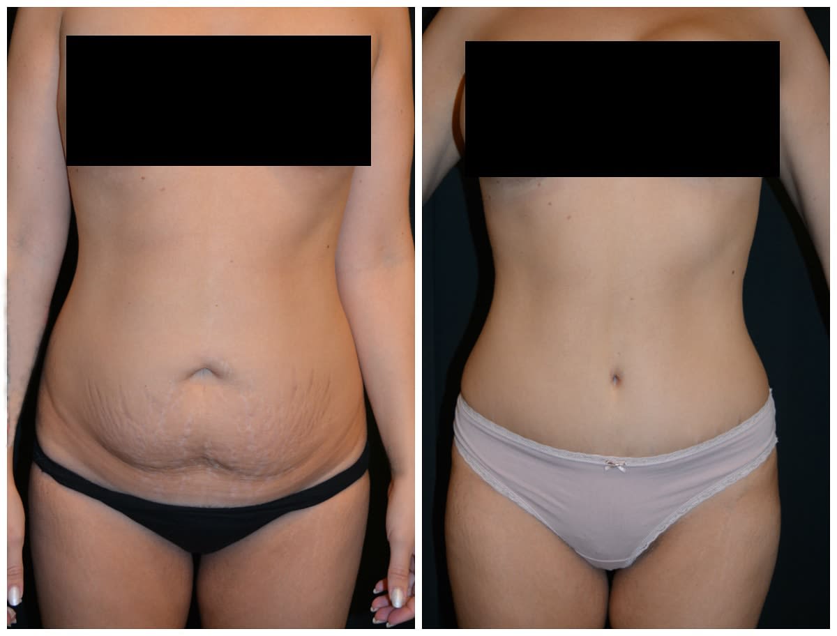 Dr Paolo Montemurro | Chirurgo Plastico Estetico di Varese | Mastoplastica, Addominoplastica, Rinoplastica & Liposuzione gallery image 8