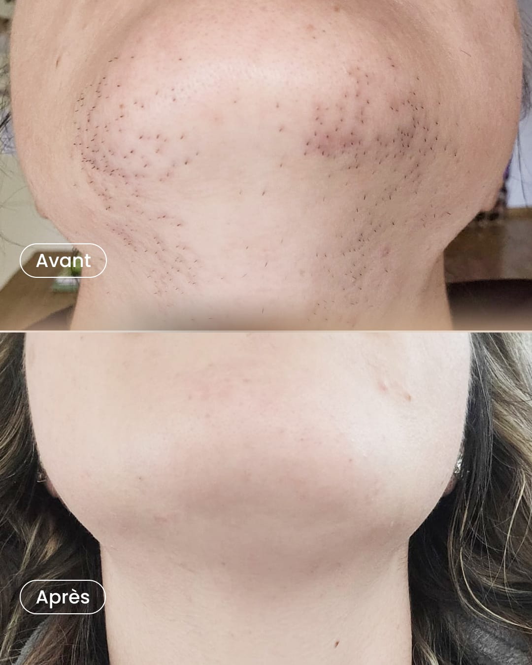 SSSKIN | Épilation Laser Définitive et Traitement PRP gallery image 10