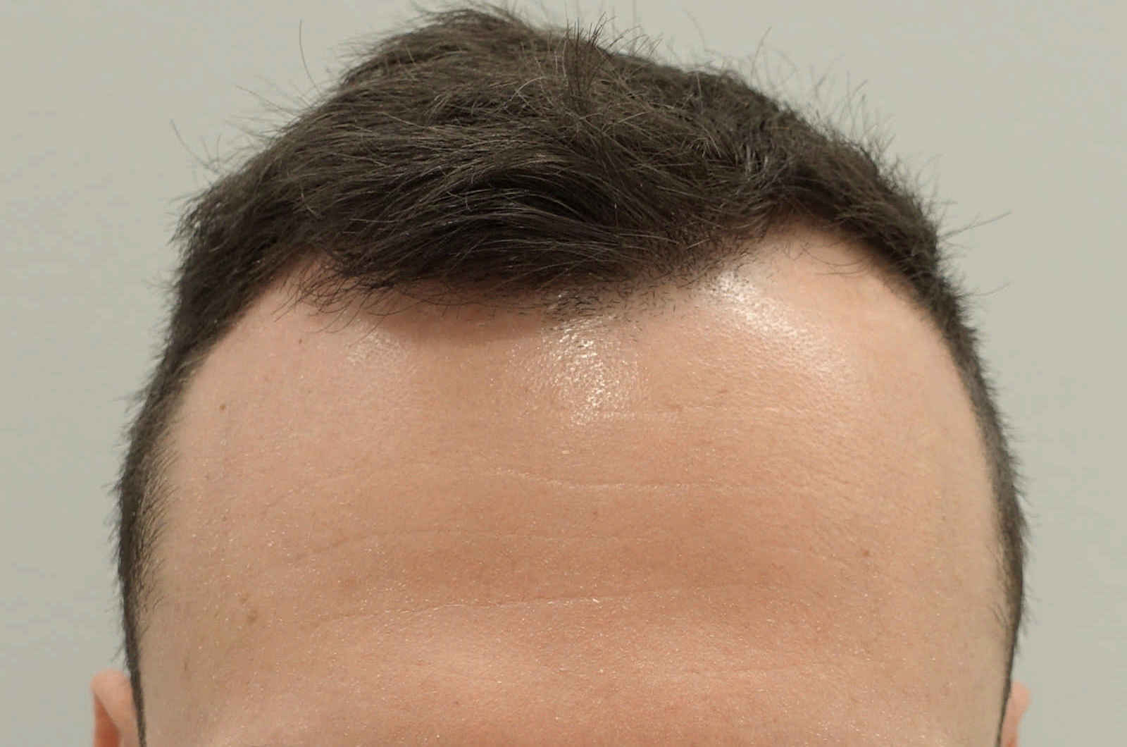 HairIn Clinic - für professionelle Haartransplantation - Est. 2010 gallery image 3