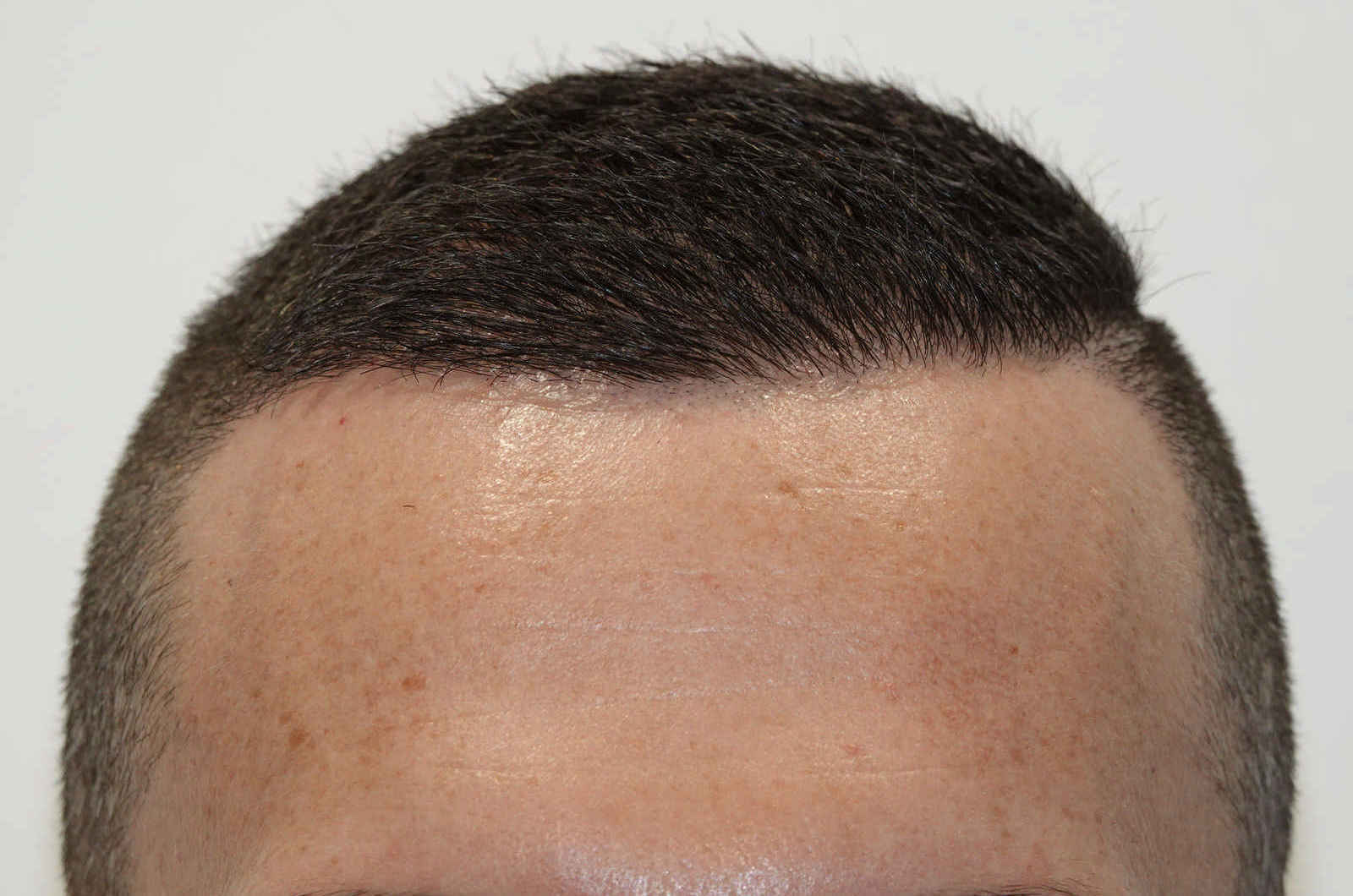 HairIn Clinic - für professionelle Haartransplantation - Est. 2010 gallery image 4