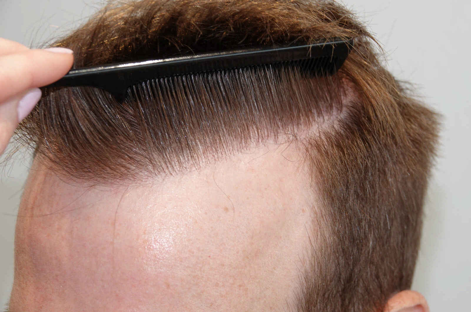 HairIn Clinic - für professionelle Haartransplantation - Est. 2010 gallery image 6