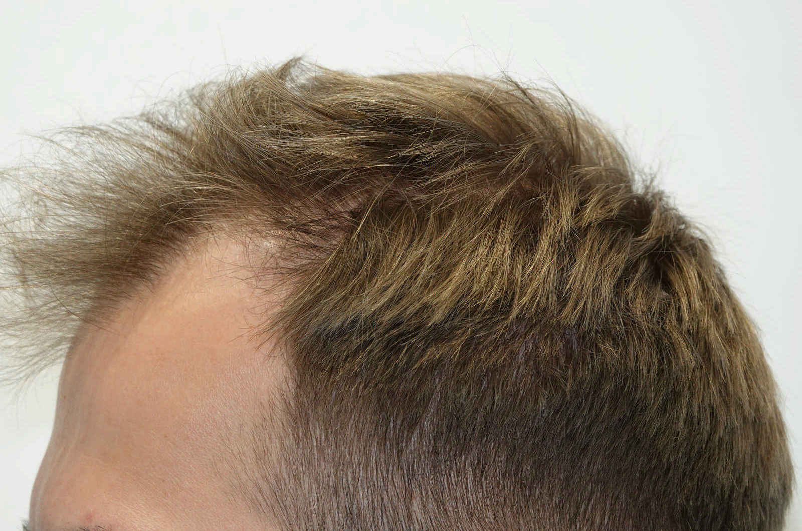 HairIn Clinic - für professionelle Haartransplantation - Est. 2010 gallery image 7