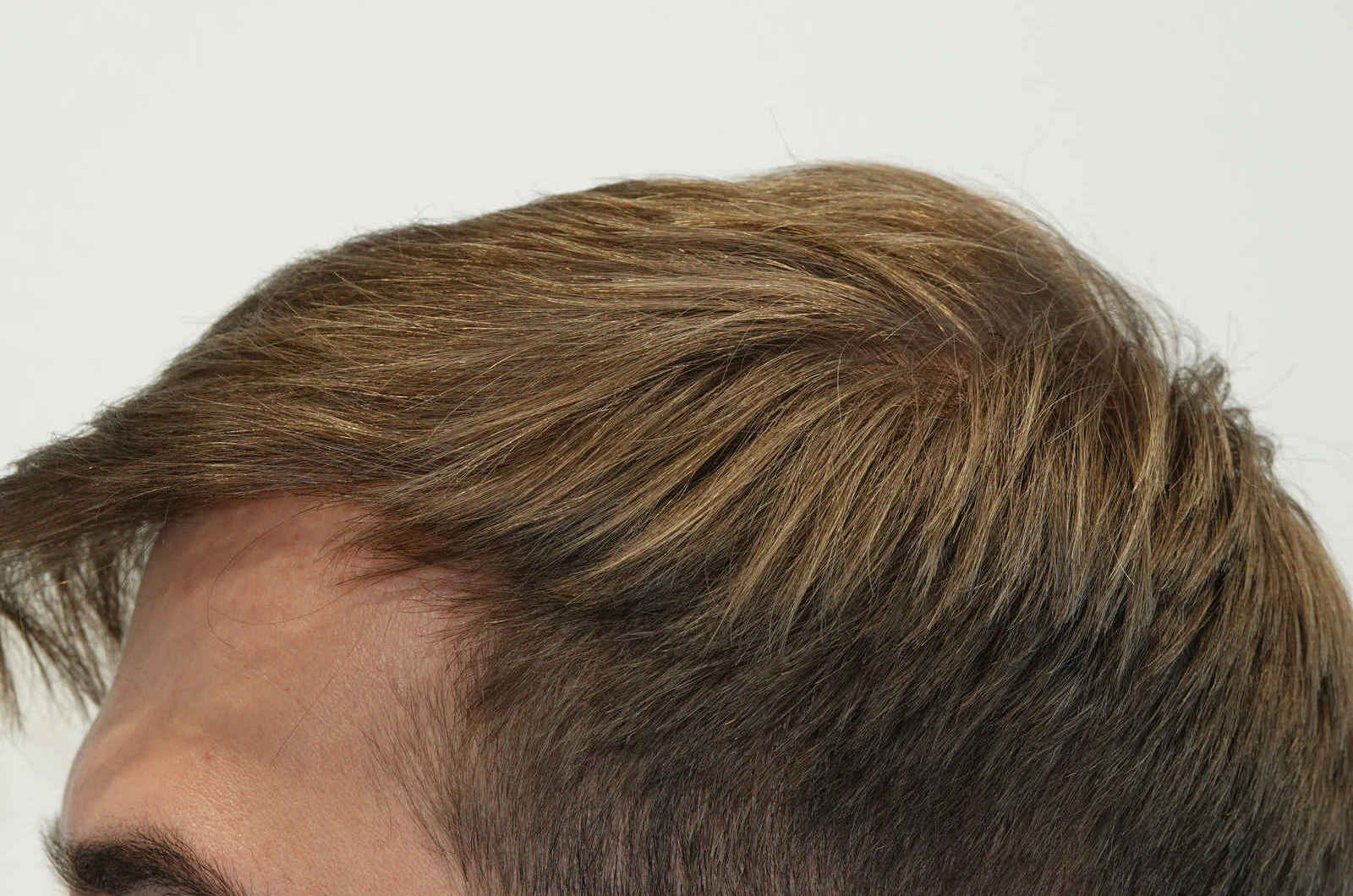 HairIn Clinic - für professionelle Haartransplantation - Est. 2010 gallery image 8