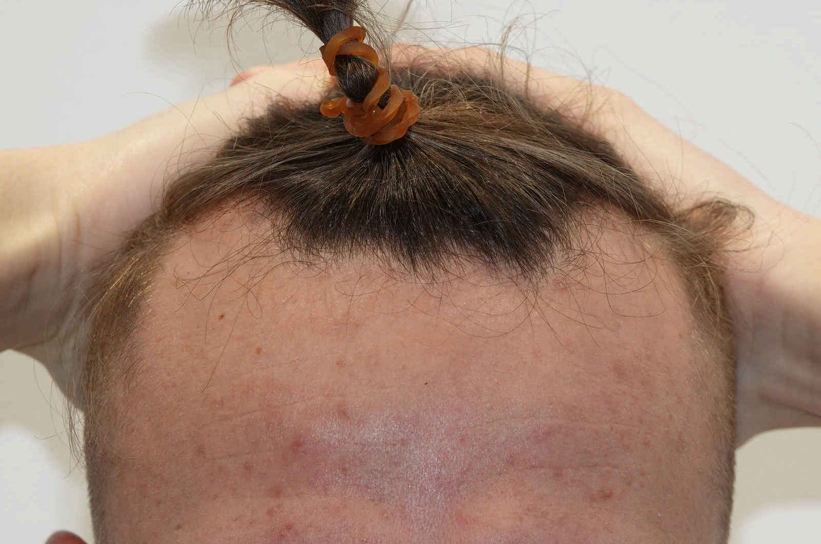 HairIn Clinic - für professionelle Haartransplantation - Est. 2010 gallery image 9