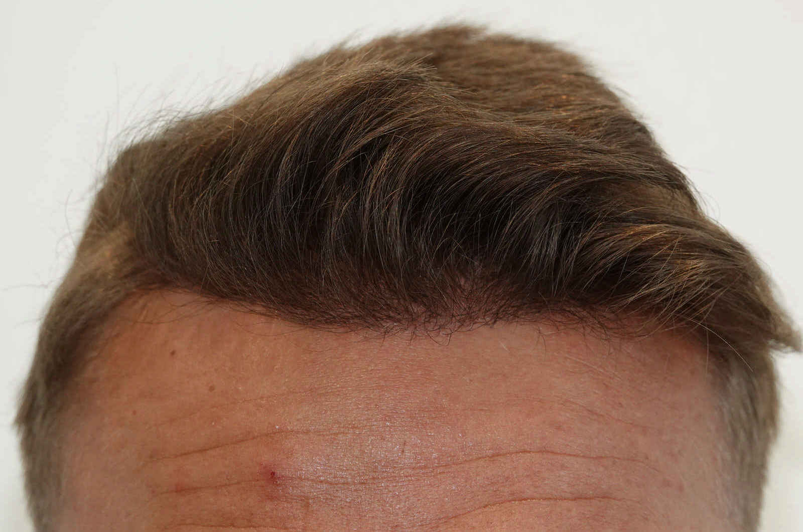 HairIn Clinic - für professionelle Haartransplantation - Est. 2010 gallery image 10