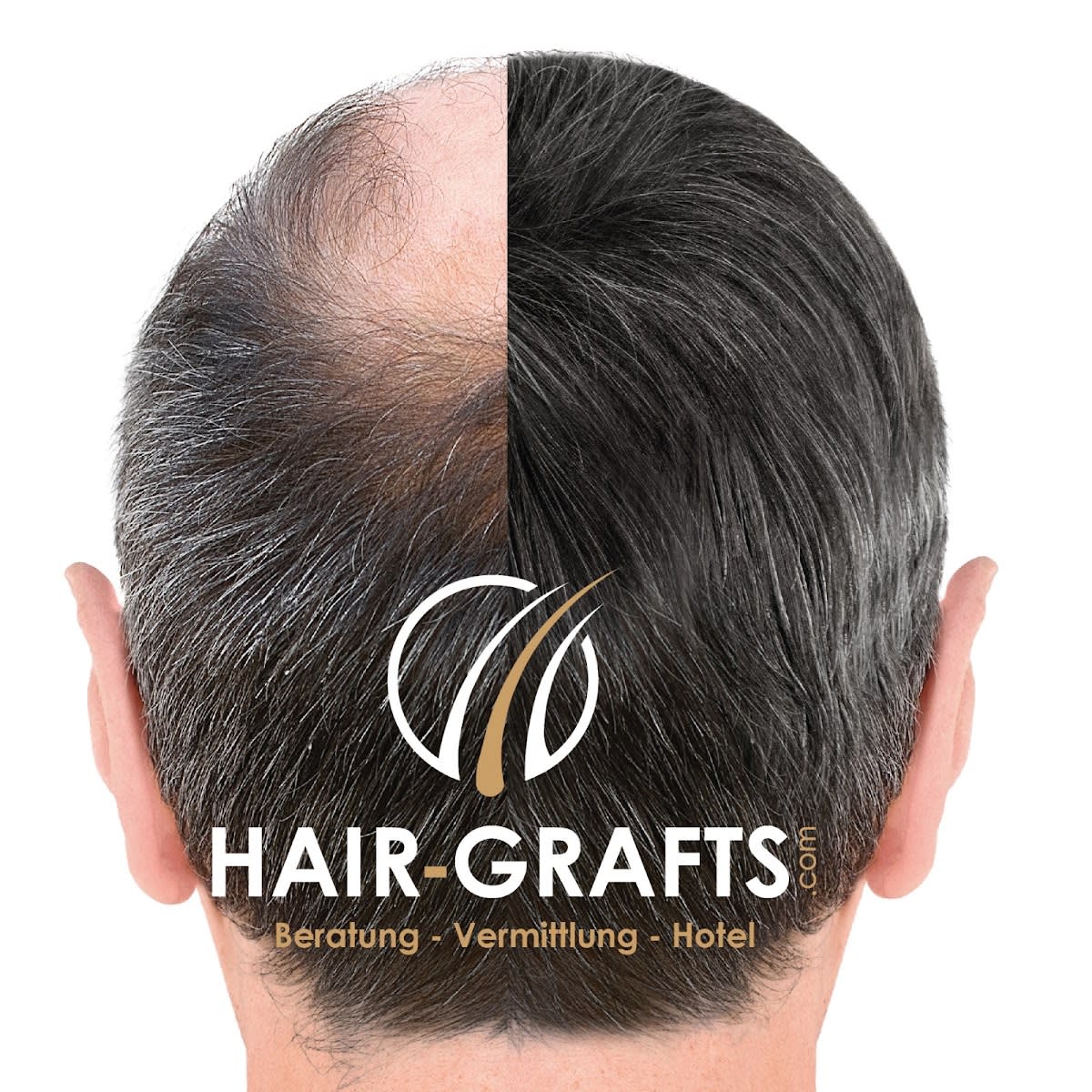 Hair Grafts gallery image 1