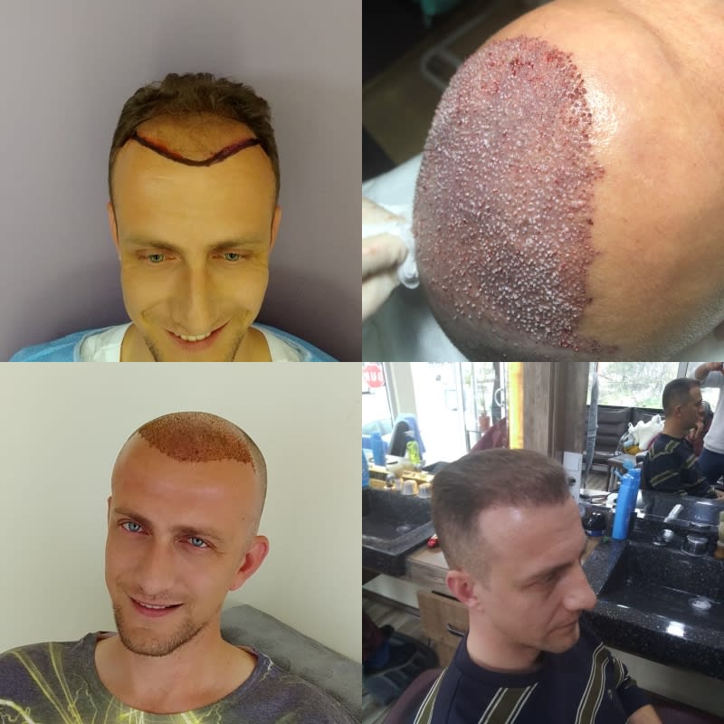 Hair Grafts gallery image 3