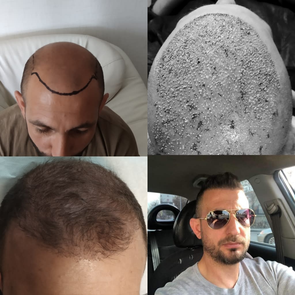 Hair Grafts gallery image 5