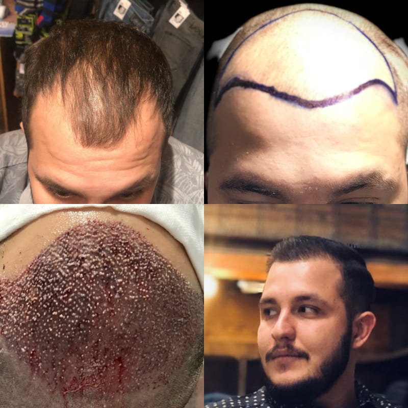 Hair Grafts gallery image 8