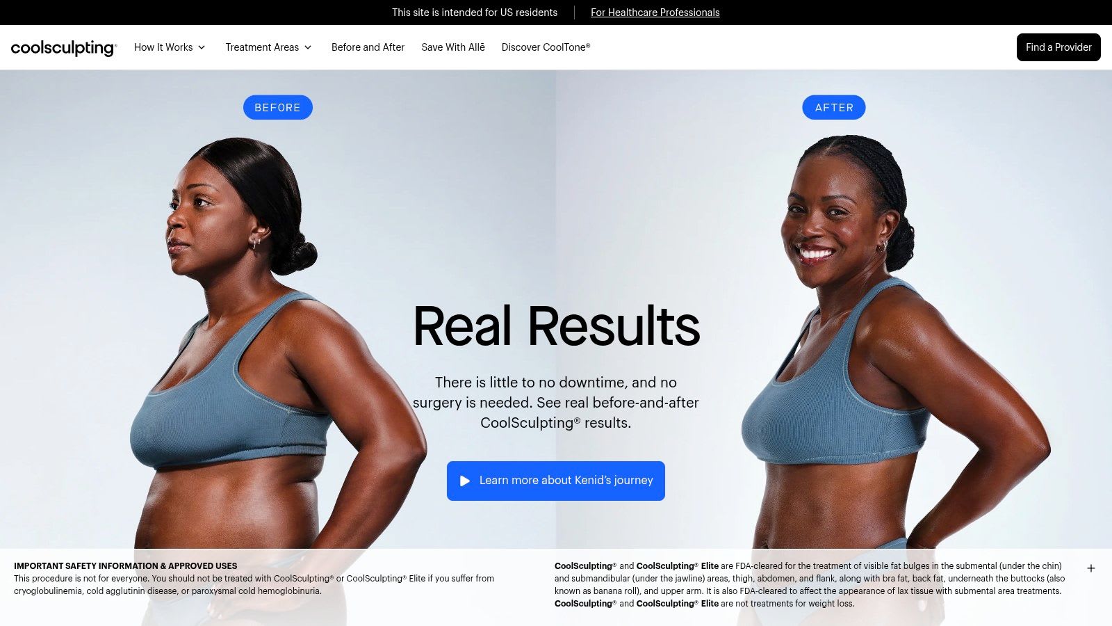 Offizielle CoolSculpting Vorher-Nachher Galerie