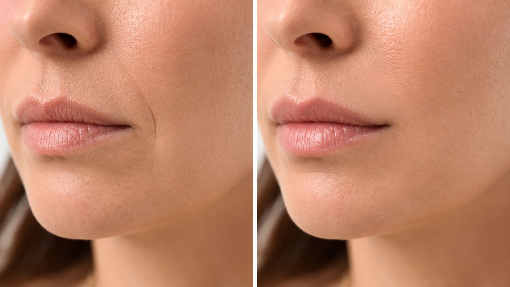 A split-screen comparison showing the before and after effects of a skin treatment on nasolabial folds.