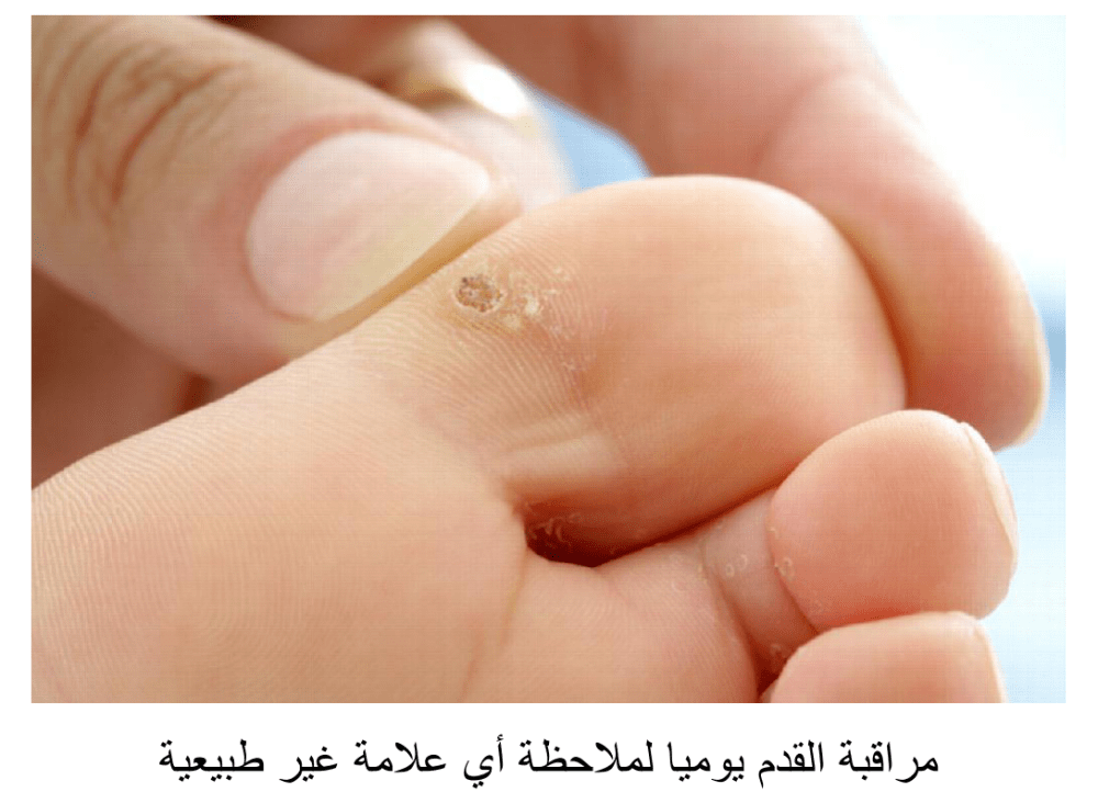 المراقبة الدائمة للقدم