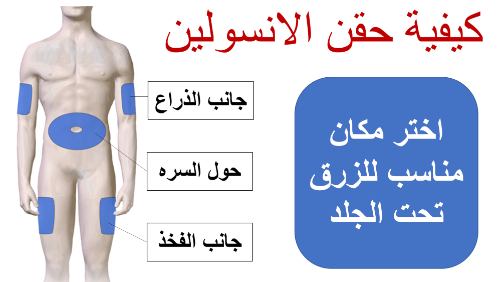 اماكن زرق الانسولين