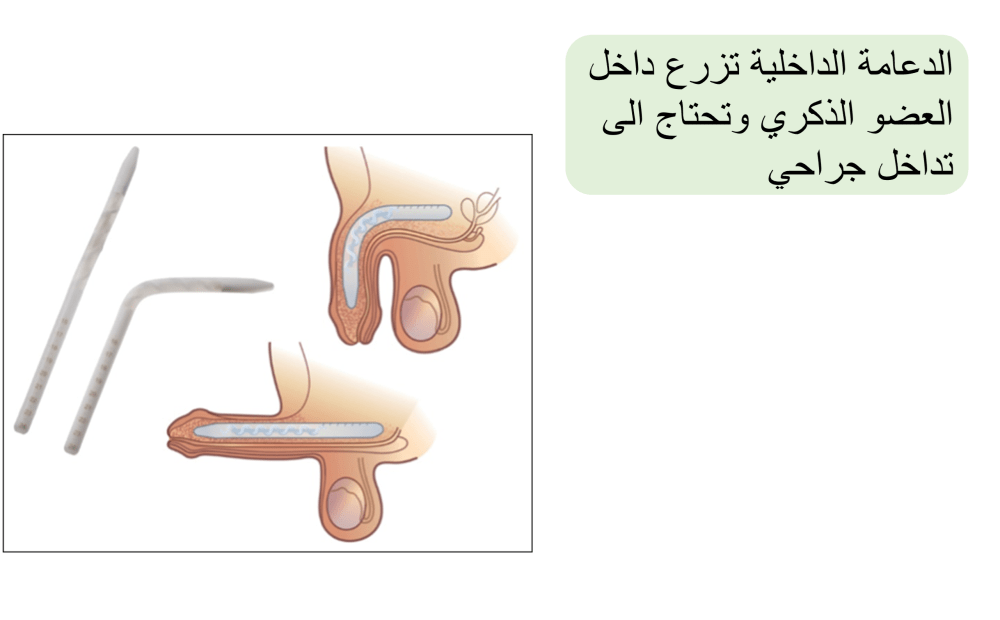 زرع دعامة اصطناعية
